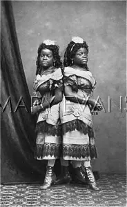 Conjoined: Millie and Christine McCoy, conjoined twins
