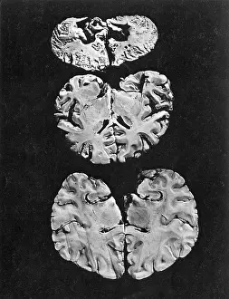 Poisoning: Minamata Disease