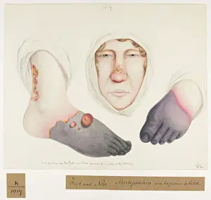 1836: Mortification of Feet and Nose
