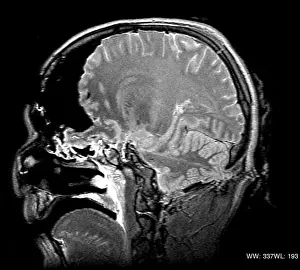 Forensic: MRI Cross Section, Wound Track