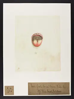 Ucl Library Services Digital Collections: Muco-gastritis and Muco-enteritis