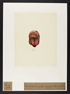 Ucl Library Services Digital Collections: Muco-gastritis with Specific Bronchitis