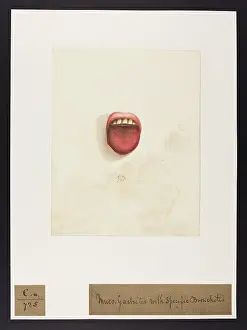 Ucl Library Services Digital Collections: Muco-Gastritis with Specific Bronchitis