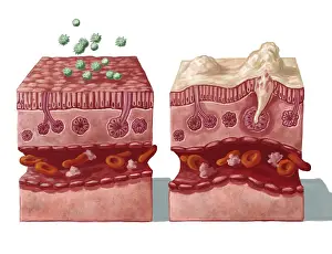 Comparing: Mucous Reaction to Allergens, Illustration