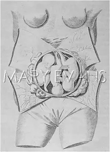 Foetus: MULTIPLE BIRTH