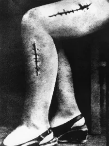 Semitic: Mutilation on a victim of an experiment in the Ravensbru