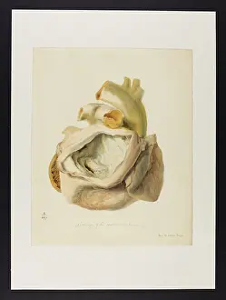 Blank: Narrowing of the Ventriculo-Ventruclar Orifice