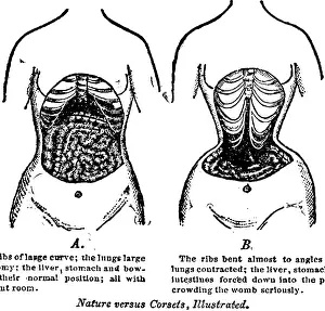 Contrasted: Nature Versus Corsets. At left is the ?