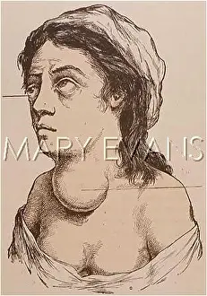 Enlargement: NECK WELLING/THYROID
