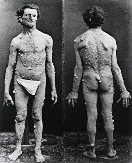 Deformity: Neurofibromatosis, 1882