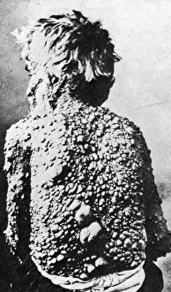 Abdomen: Neurofibromatosis