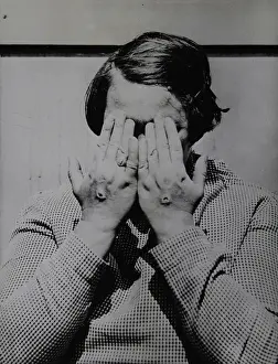 Stigmata: A new case of stigmata on the hands