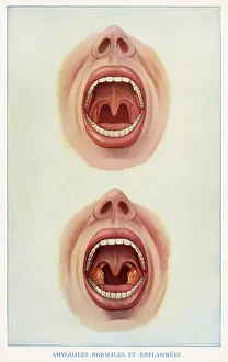 Normal: Normal and inflamed tonsils
