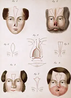 Textbook: Nose Reconstruction, 1815 Medical Text