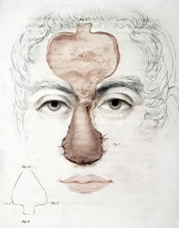 Procedure: Nose Reconstruction, 1815 Medical Text