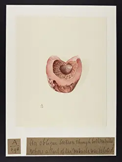 Verso: An Oblique Section through both Ventricles