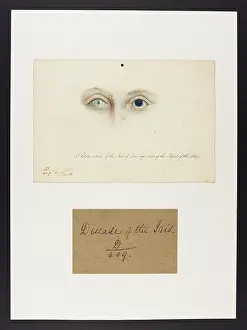 Iris: Obliteration of the Iris and Pupil
