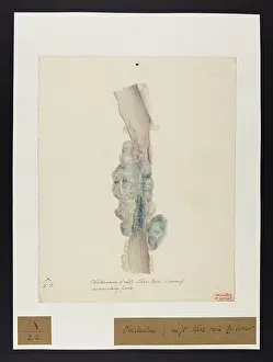 Vein: Obliteration of Left Iliac Vein