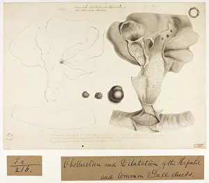 Ducts: Obstruction and Dilatation of Hepatic and Common Gall Ducts