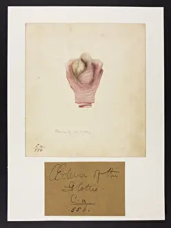 Oedema: Oedema of the Glottis