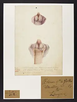 Ucl Library Services Digital Collections: Oedema of Glottis. Ulceration of larynx