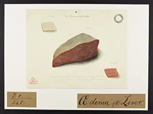 Liver: Oedema of the Liver