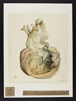 Blank: Ossification of the Aortal Valves