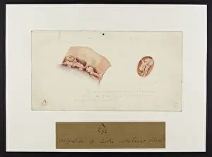 1831: Ossification of Aortic Semi Lunar Valves