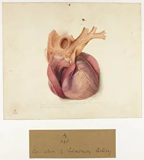 1831: Ossification of Pulmonary Artery