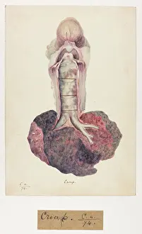 Ucl Library Services Digital Collections: Ossification of the Trachea