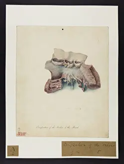 Valves: Ossificaton of the Valves of Heart