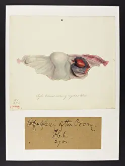 Ha´pital: Ovarium containing Coagulated Blood