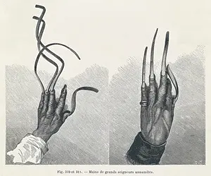 Fingernails: OVERGROWN FINGERNAILS