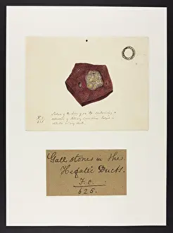 Liver: Ox: Gall Stones