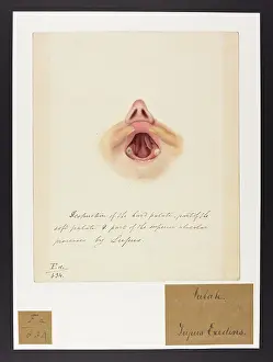 Blank: Palate: Lupus Exedens