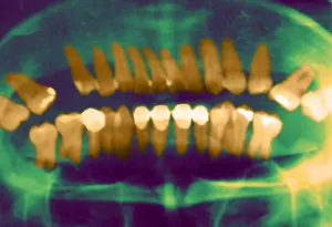 X Ray: Panoramic Dental X-Ray