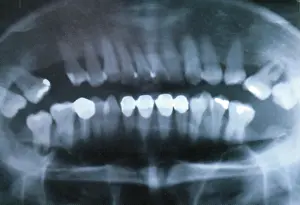 Procedure: Panoramic Dental X-Ray