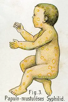 Genital: Papulomustulous syphilis, 1902