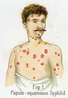 Illnesses: Papulosquamous syphilis, 1902