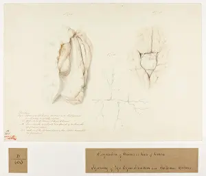 Paralysis: Paralysis, Ossification of Arteries in the Brain