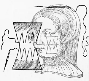 Stitches: Pare Suture, 1500s