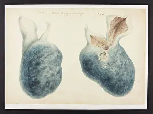 Lungs: Partial Atrophy of Lungs