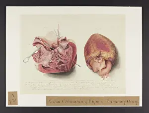 Blank: Partial Obliteration of Orifice of Pulmonary Artery