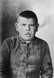 Deformity: Patient of Cesare Lombroso