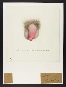 Belonging: Penis: Diabetes Mellitus
