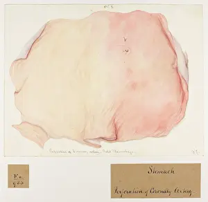 Fatal: Perforation of Coronary Artery, Stomach
