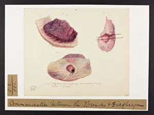 Diaphragm: Perforation of the Diaphragm