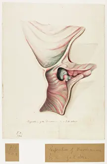 Gall: Perforation of the Duodenum by a Gall Stone