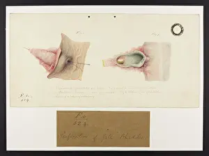 1831: Perforation of Gall Bladder and Colon
