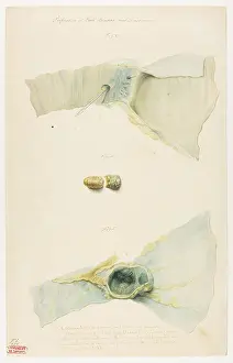 Gall: Perforation of Gall Bladder and Duodenum